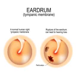 Perforated eardrum illustration